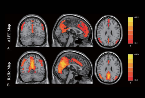 静息态功能磁共振(rs-fMRI)数据处理