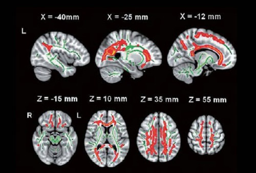 弥散磁共振(dMRI)数据处理
